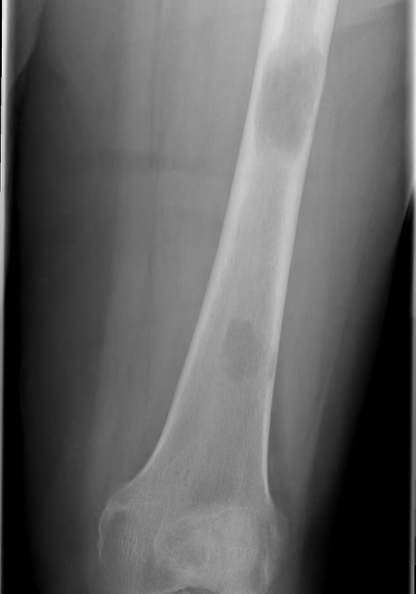 Metastasis Femoral Shaft0002